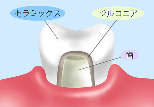 ジルコニア