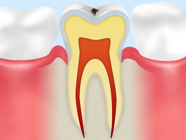 STEP 01ごく初期の虫歯