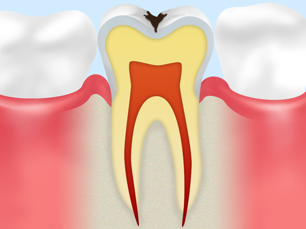 STEP 02エナメル質の虫歯
