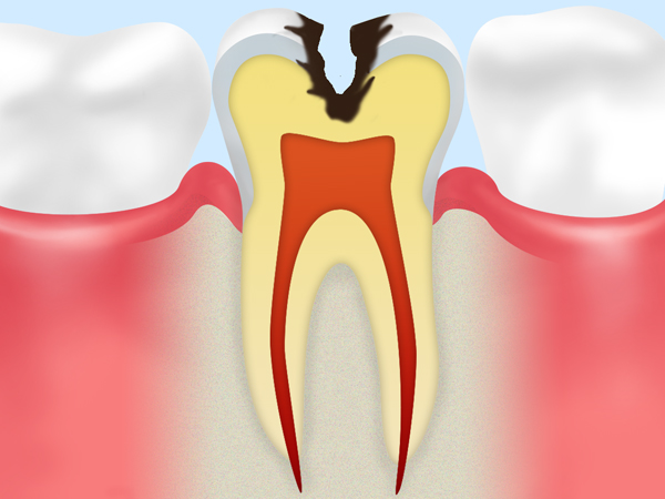 STEP 03 象牙質の虫歯
