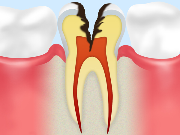STEP 04 神経に達した虫歯
