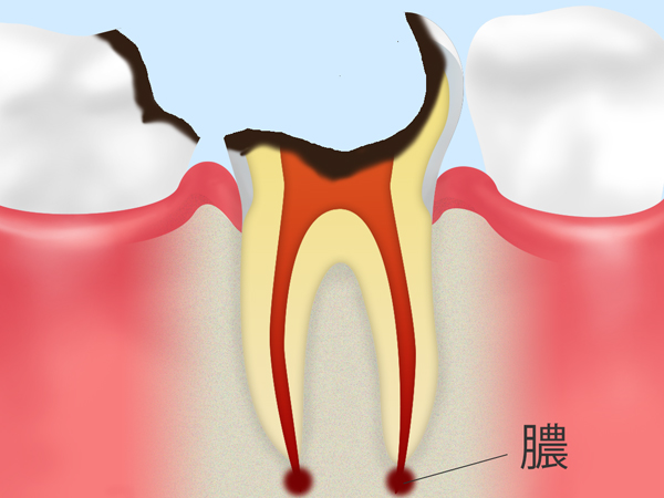 STEP 05歯根に達した虫歯
