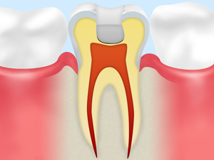 根管治療前に行う深い虫歯の治療「間接覆髄法」