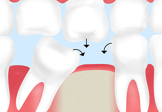 1本の歯を失うことは、お口の咬み合わせが悪くなり、全身疾患にもつながります