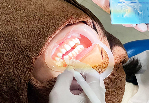 STEP5 ホワイトニング剤塗布